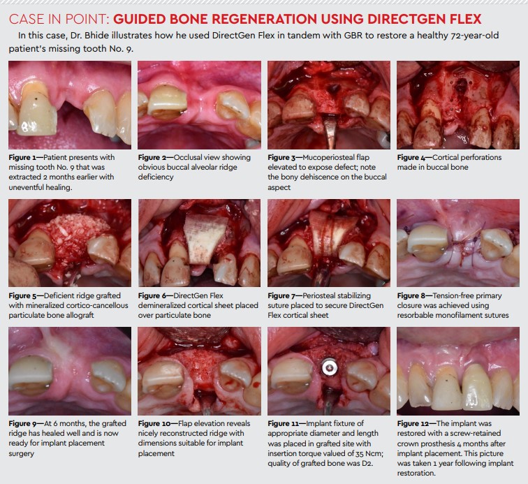 case in point guided bone regeneration using directgen flex